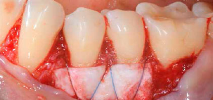 Suturing on tooth surface of the folded Smartbrane coated with xHyA gel