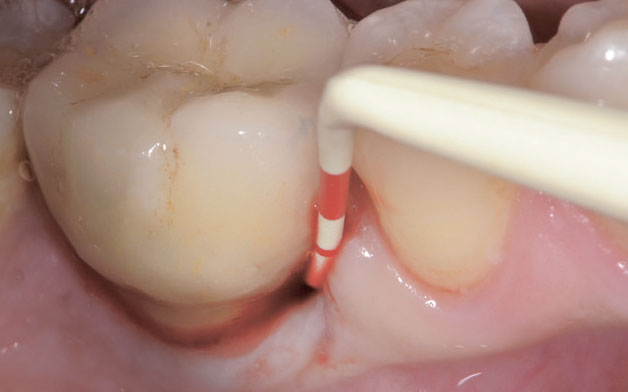 Implants ar zondēšanas dziļumu ≤ 5 mm un asiņošanu zondējot (BOP+)